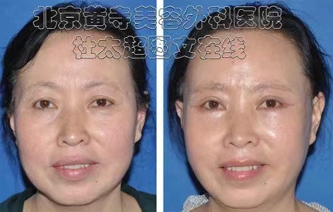 眼皮周围皮肤越来越松弛怎么办？