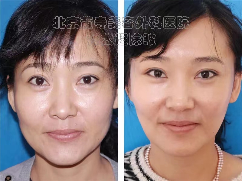 小切口除皱有什么样的风险？