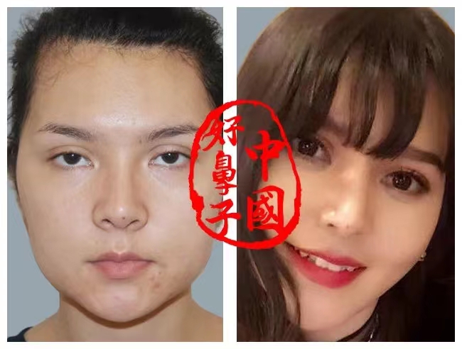 隆鼻全过程讲解。
