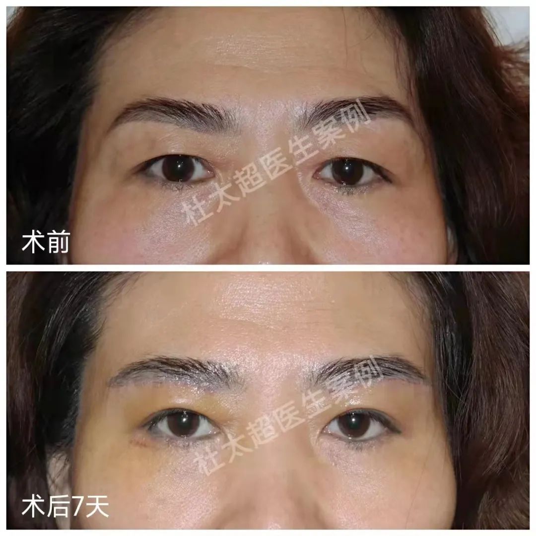 哪些情况需要做上眼睑手术呢？
