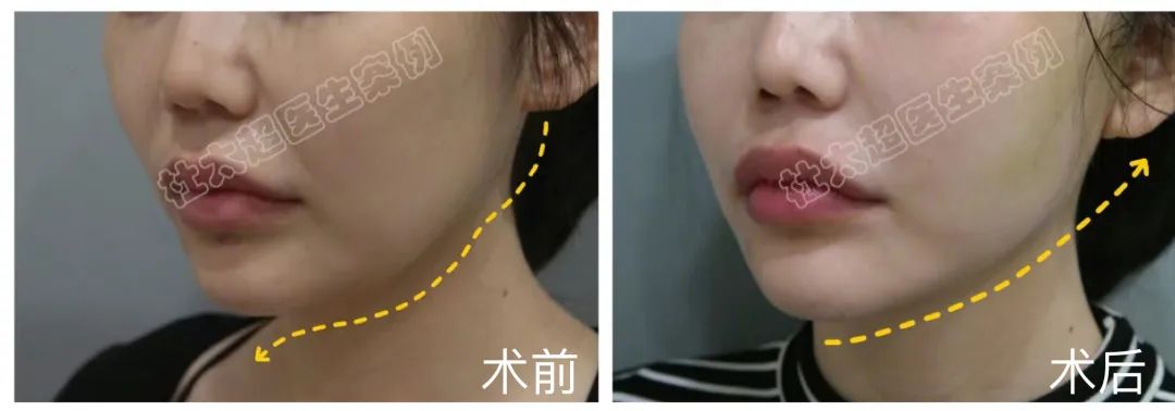 面部老化丰满苹果肌该怎么做？