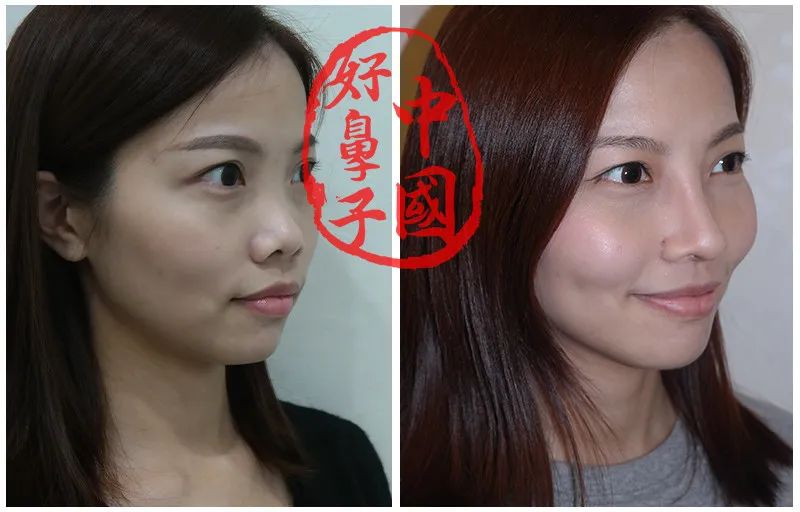 鼻假体雕刻难在哪里？