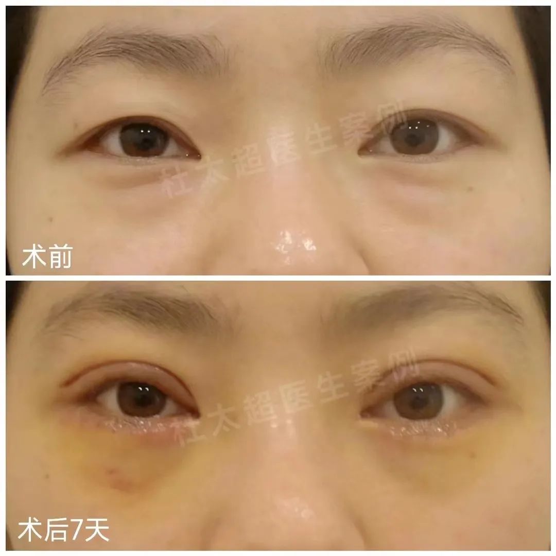 眼袋是怎么形成的呢？