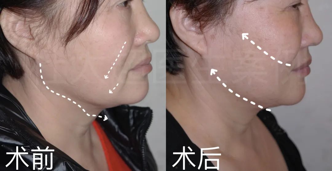 面部年轻化从这里开始了解...