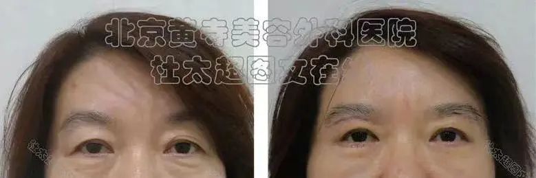 眉毛下垂，太让人显老，这样整……