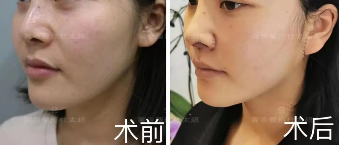 法令纹用哪种方式祛除最好...