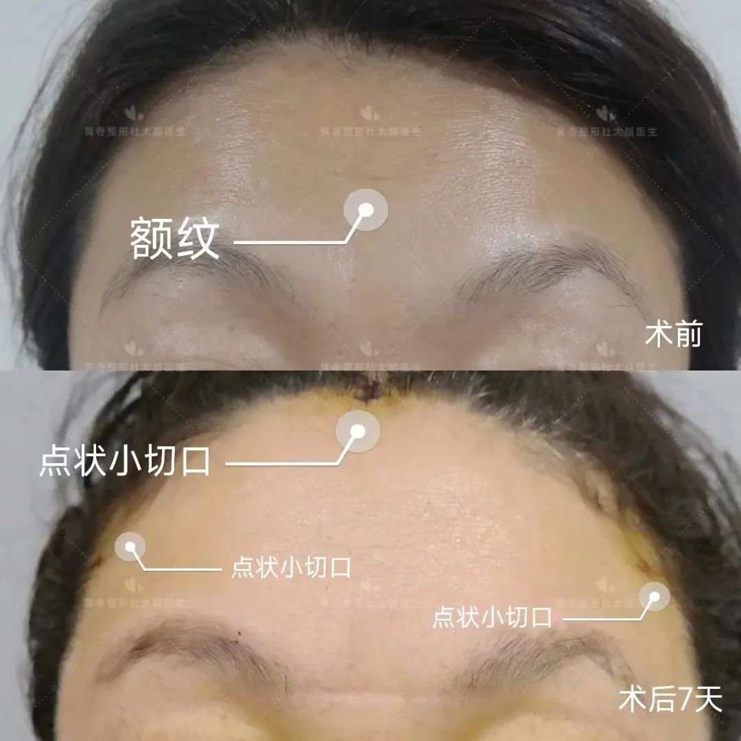 为什么年纪轻轻就有抬头纹？抬头纹怎么去除？
