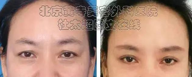 眉毛下垂，太让人显老，这样整……