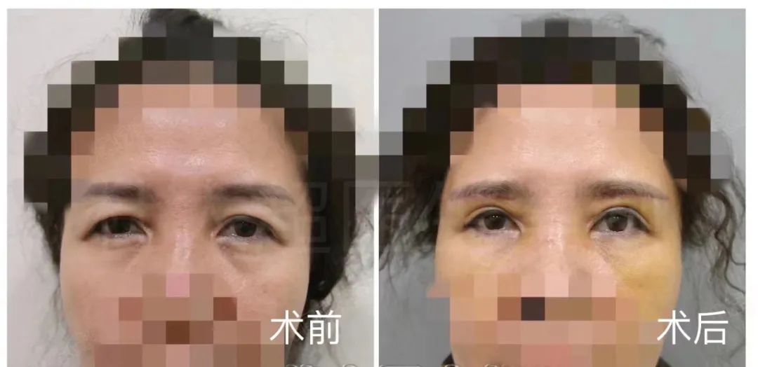 耷拉的眼皮怎么处理？