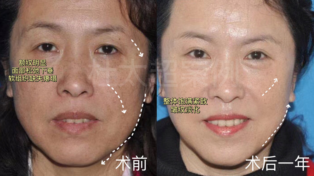 发现这样改善法令纹，超有效！