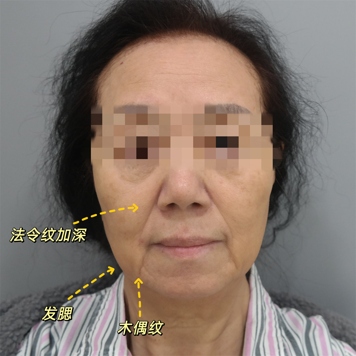70岁不服老来北京做了拉皮，术后效果很惊艳，年轻了10多岁！