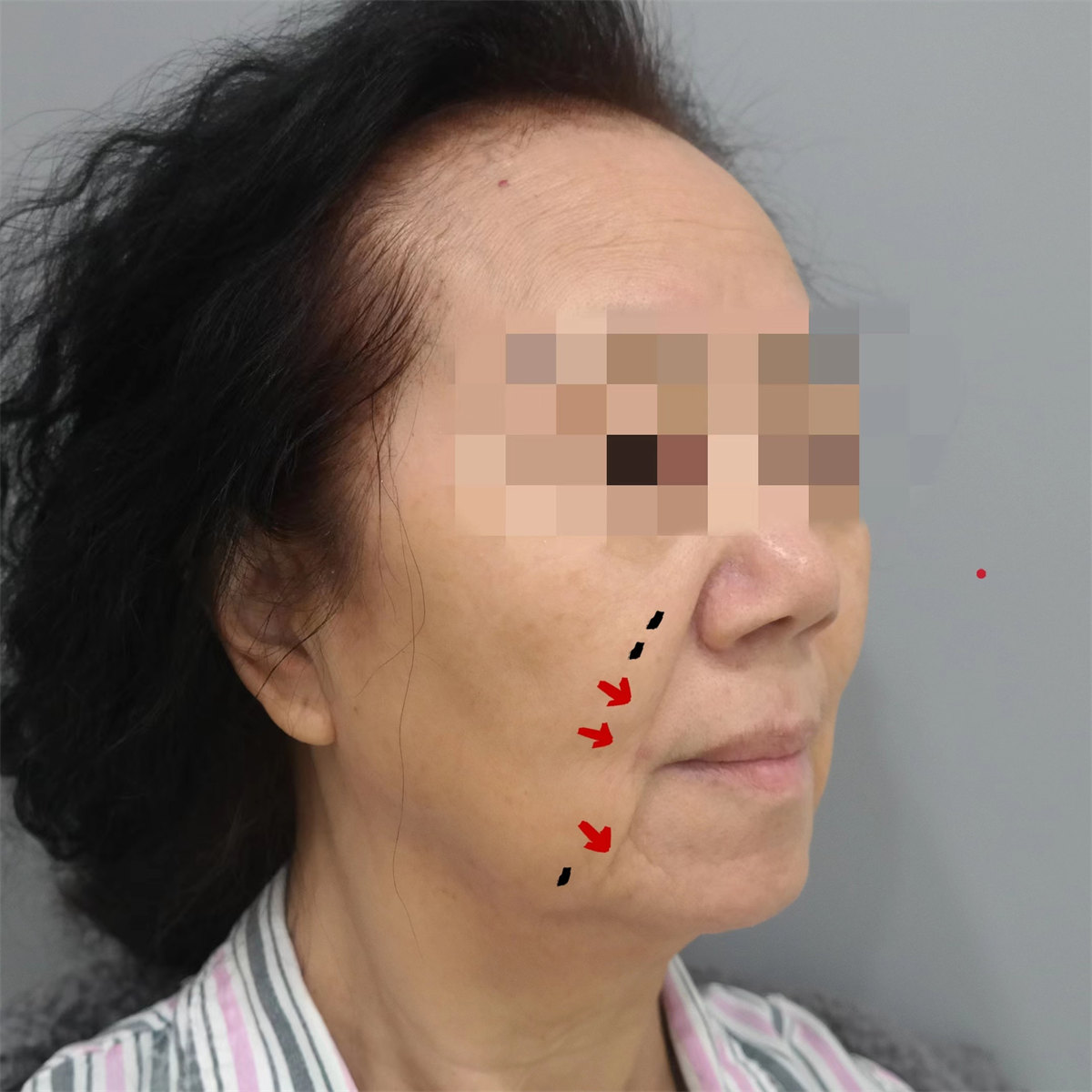 70岁不服老来北京做了拉皮，术后效果很惊艳，年轻了10多岁！