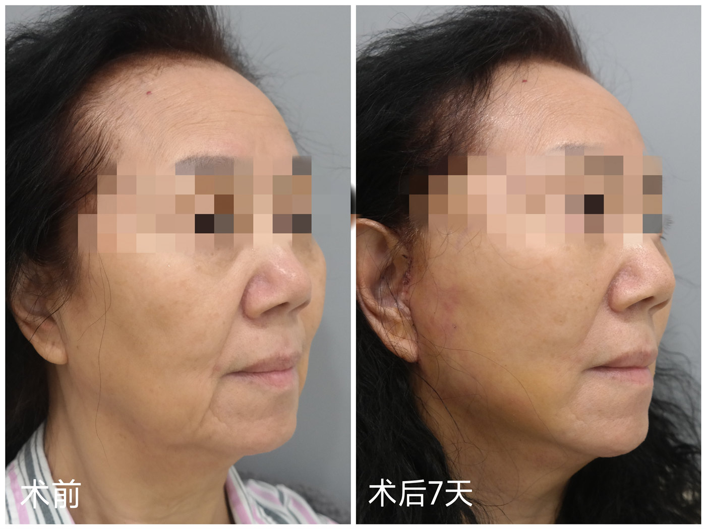 70岁不服老来北京做了拉皮，术后效果很惊艳，年轻了10多岁！
