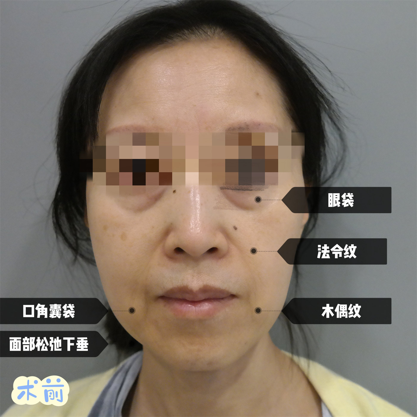 姐妹四人一起来做拉皮手术，术后1个月效果很惊艳！