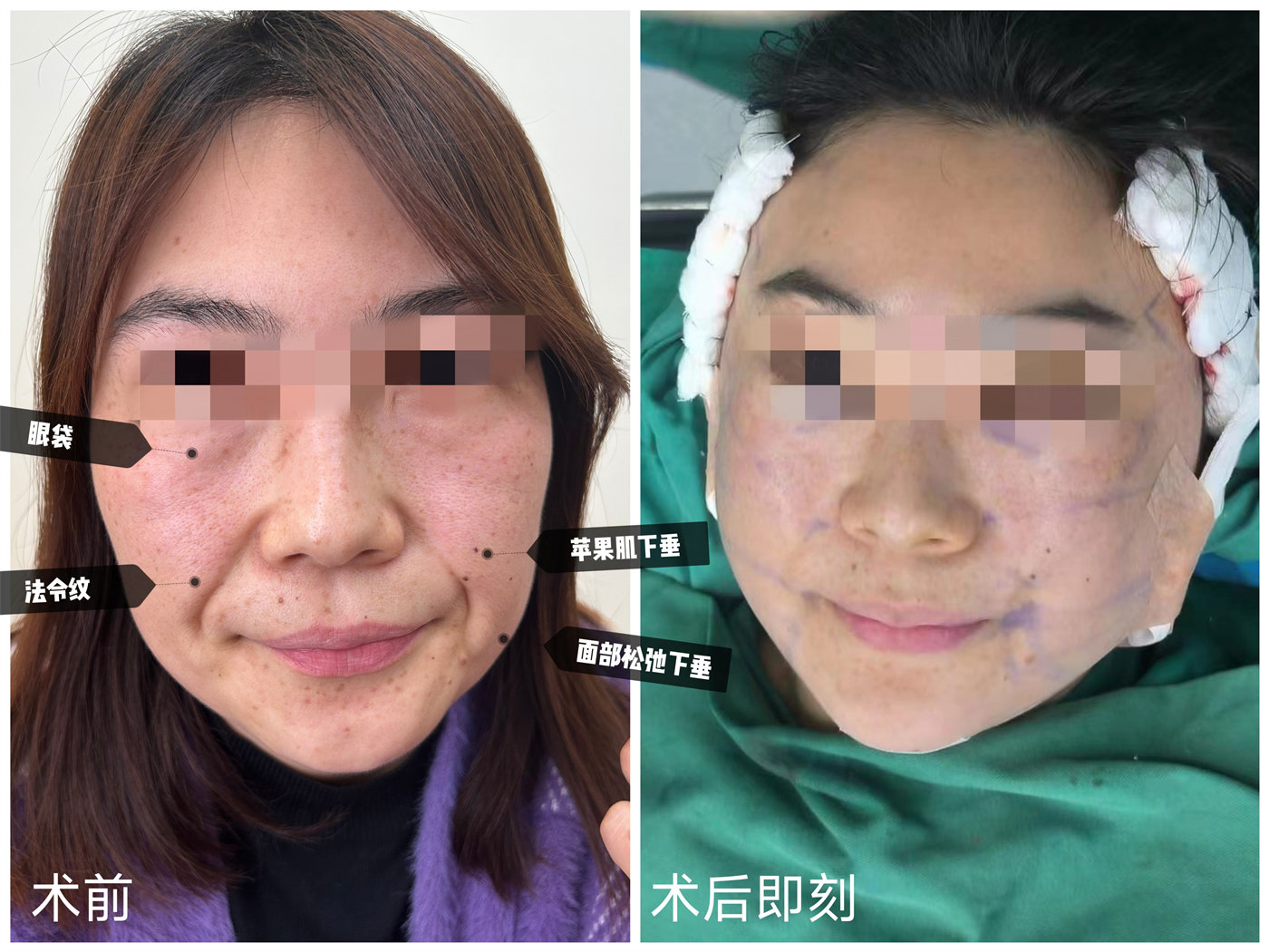 苹果肌下垂、面颊凹陷、法令纹，分享拉皮手术过程及感受
