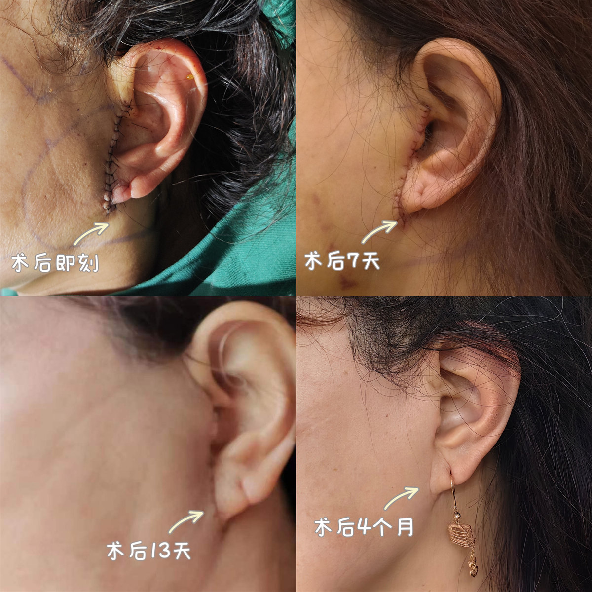 做拉皮手术怎么才能不留疤痕？