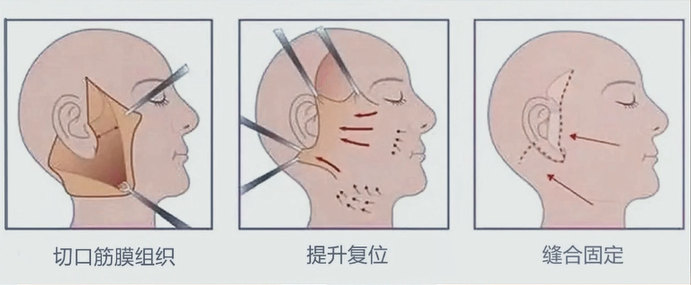 解决面部松弛、脂肪堆积、发腮问题！线雕拉皮怎么选？
