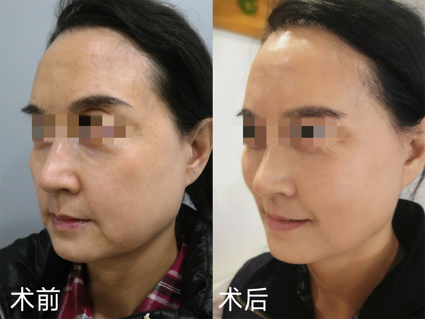 医美小白想做拉皮手术，必须知道这6件事！