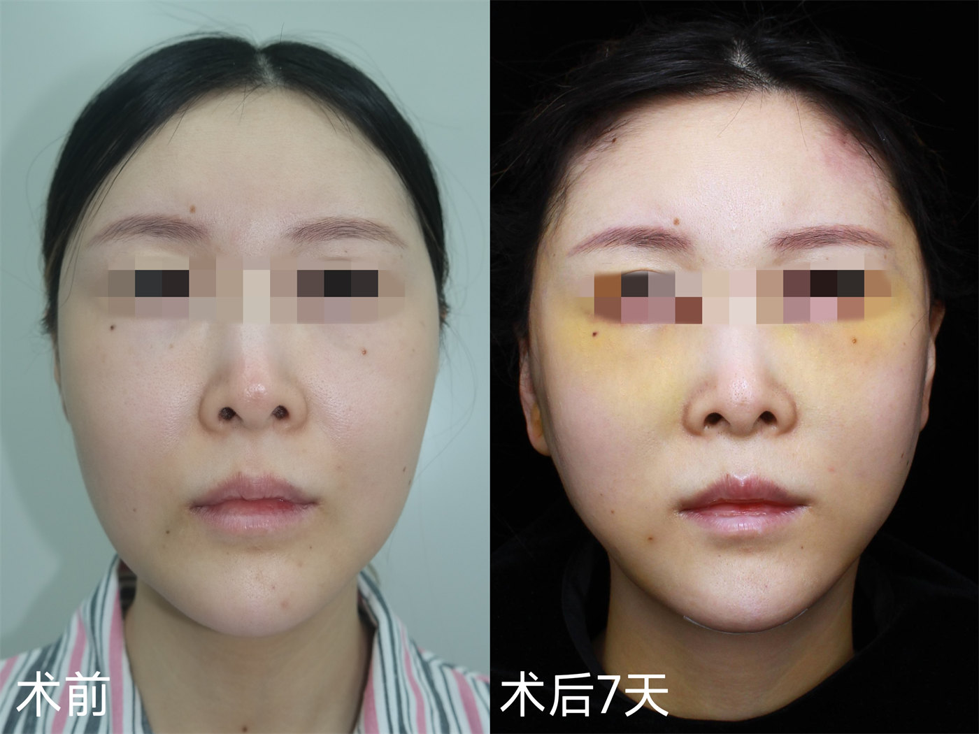 36岁女士拉皮全程记录，术后7天减龄、少女感十足！