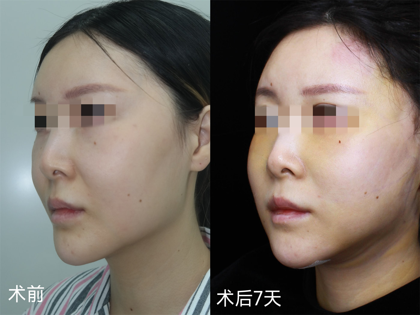 36岁女士拉皮全程记录，术后7天减龄、少女感十足！