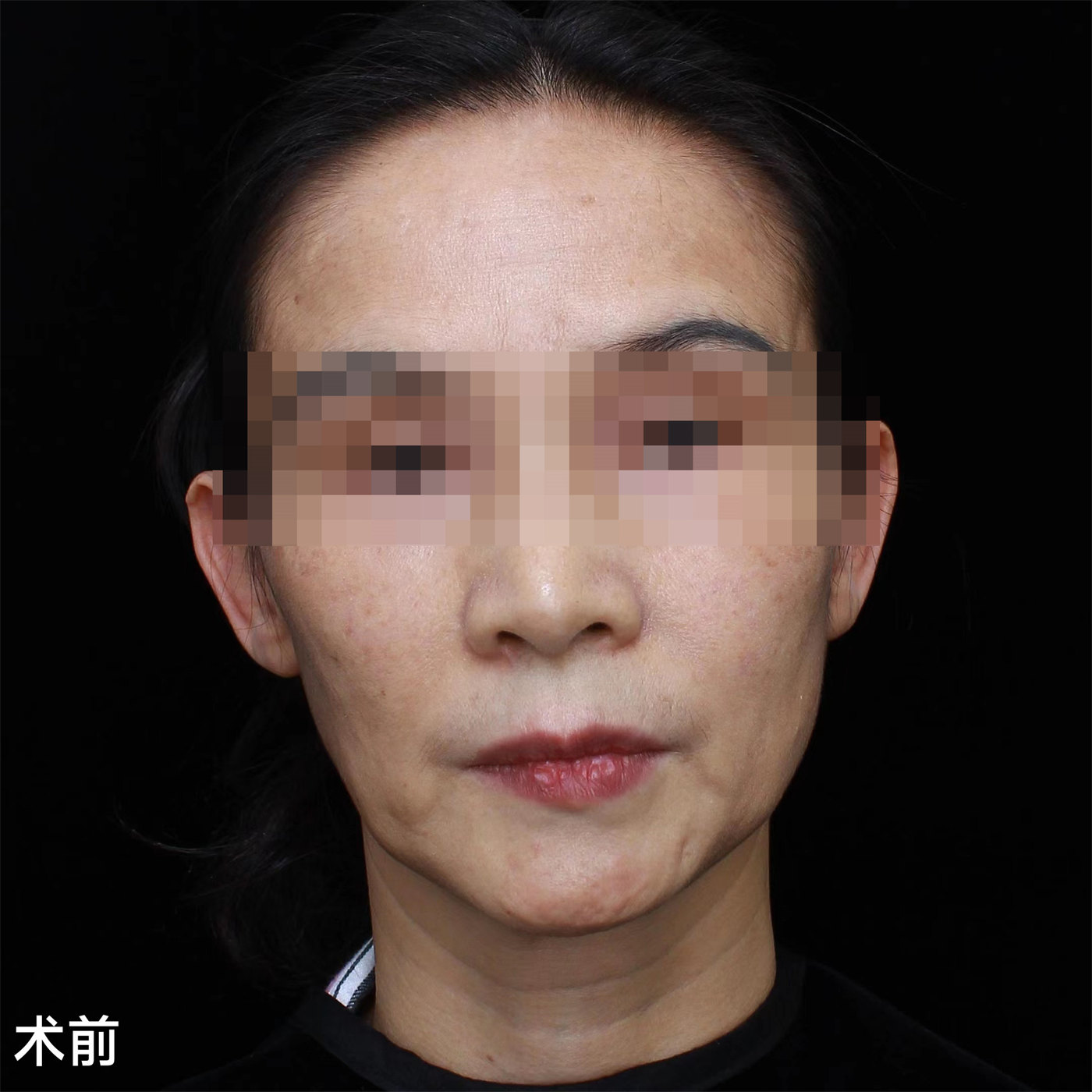 45岁比同龄人显老，不甘心向岁月妥协，做了拉皮手术！
