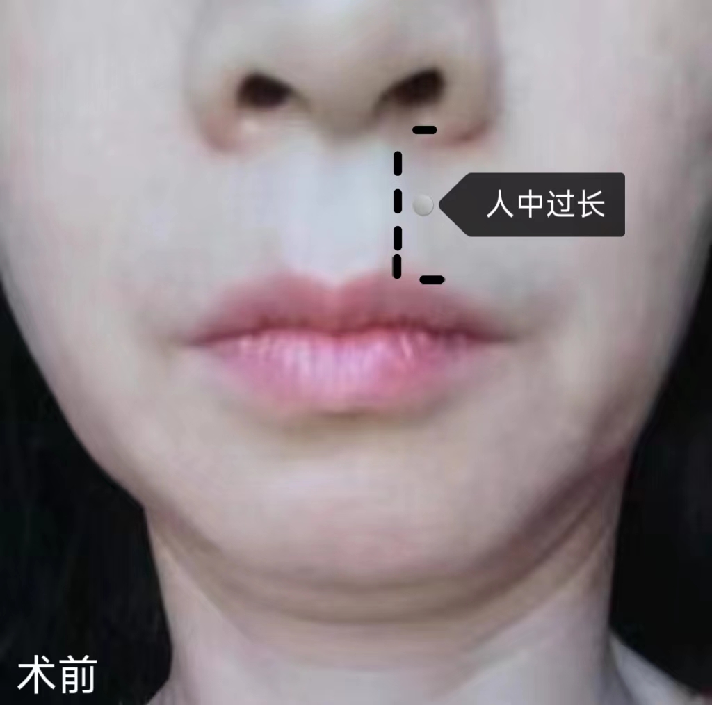 45岁比同龄人显老，不甘心向岁月妥协，做了拉皮手术！