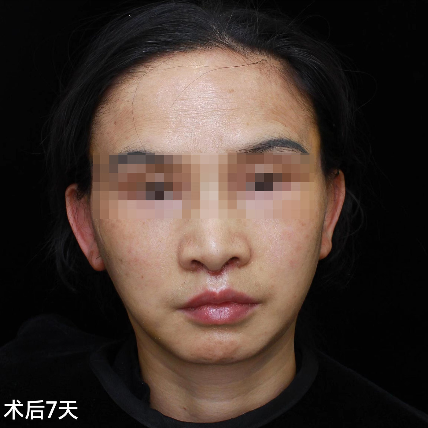 45岁比同龄人显老，不甘心向岁月妥协，做了拉皮手术！