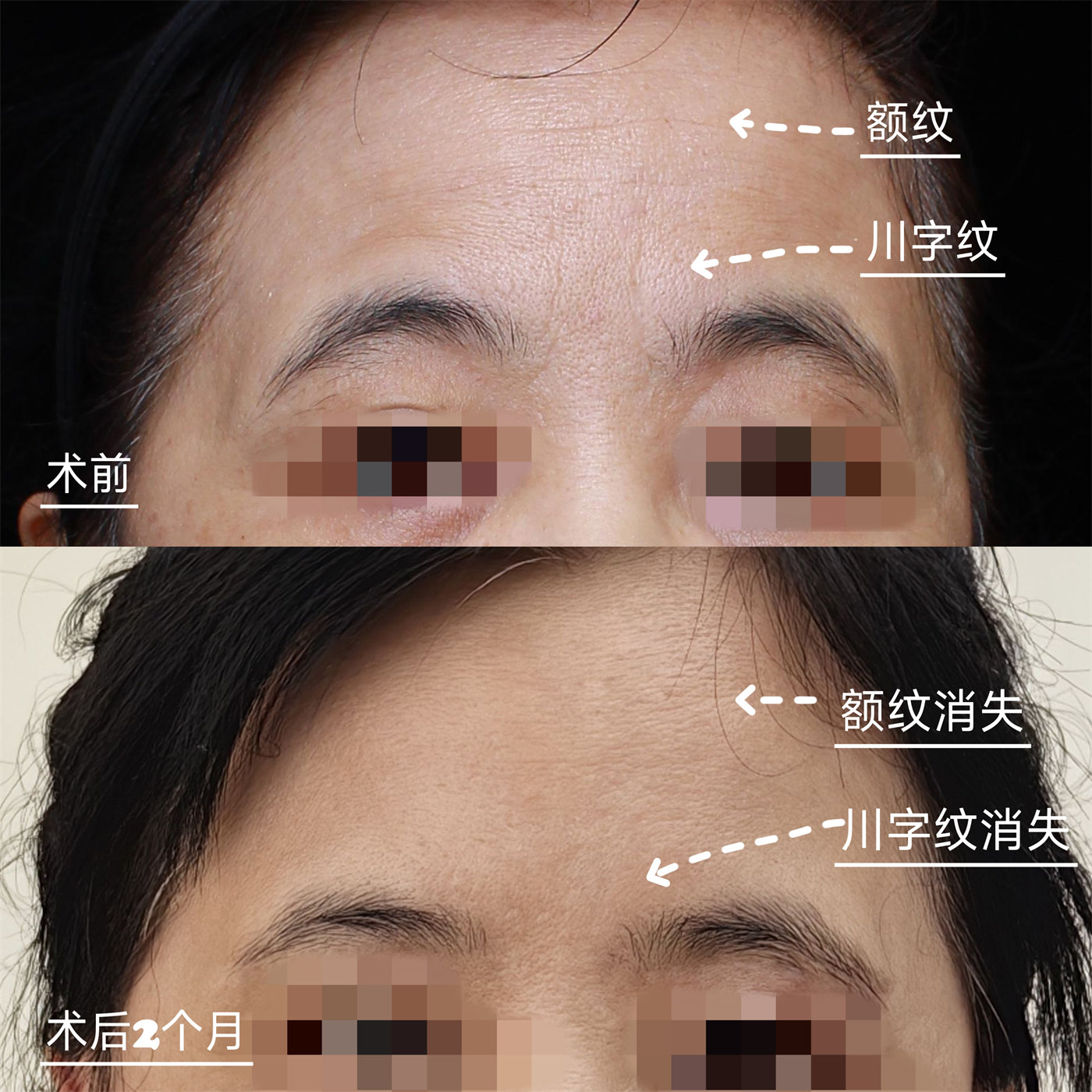 50+做完上面部除皱，术后2个月川字纹、额纹都不见了