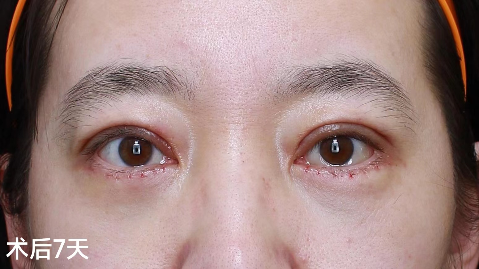 年轻人眼周衰老，对症下药这样做！