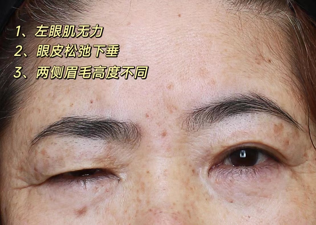 病理性眼部肌无力，这样做，可实现自主抬起上眼睑！