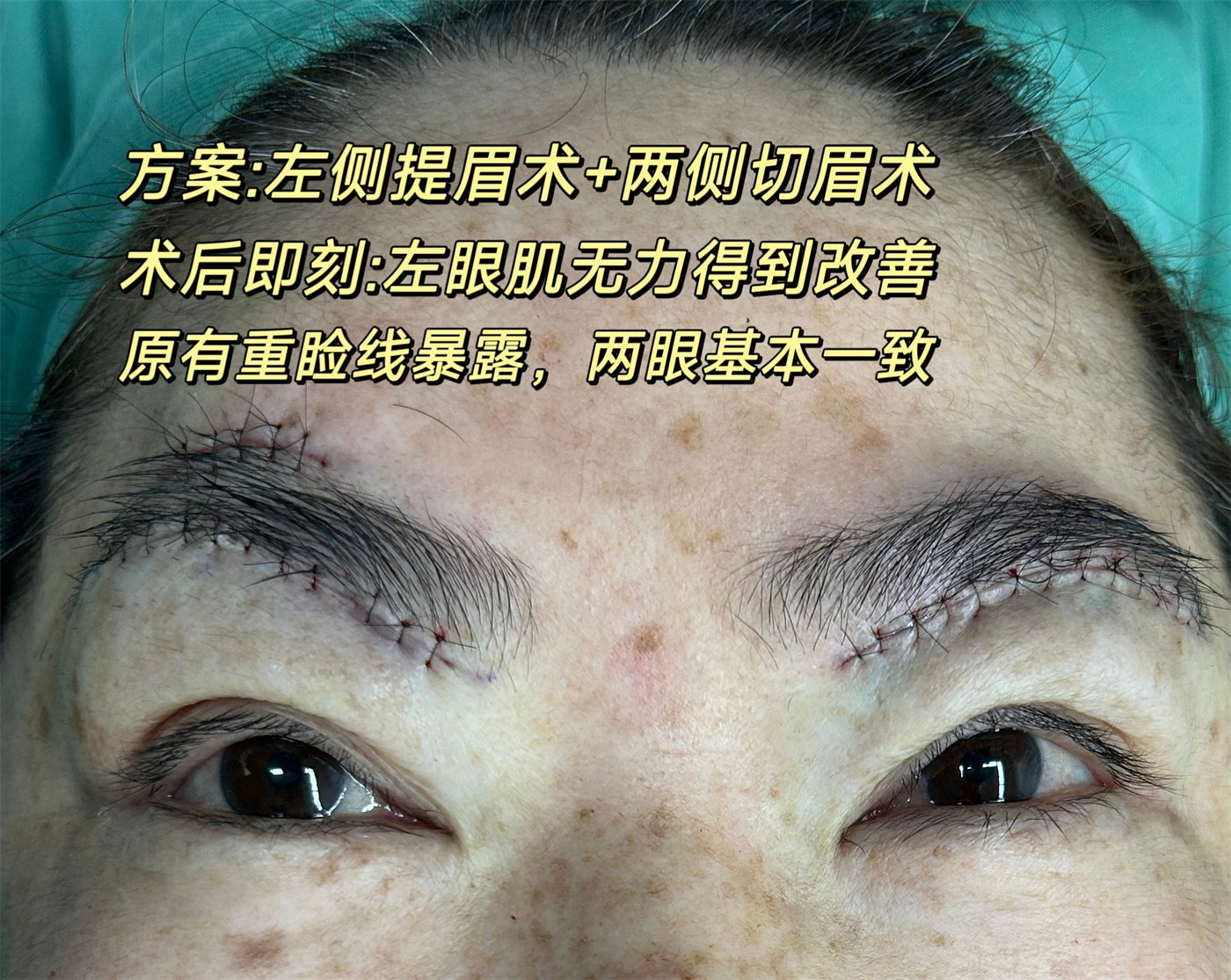 病理性眼部肌无力，这样做，可实现自主抬起上眼睑！