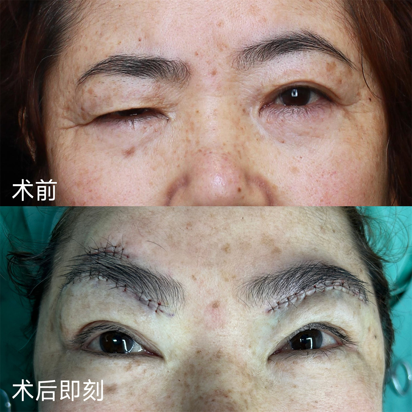 病理性眼部肌无力，这样做，可实现自主抬起上眼睑！