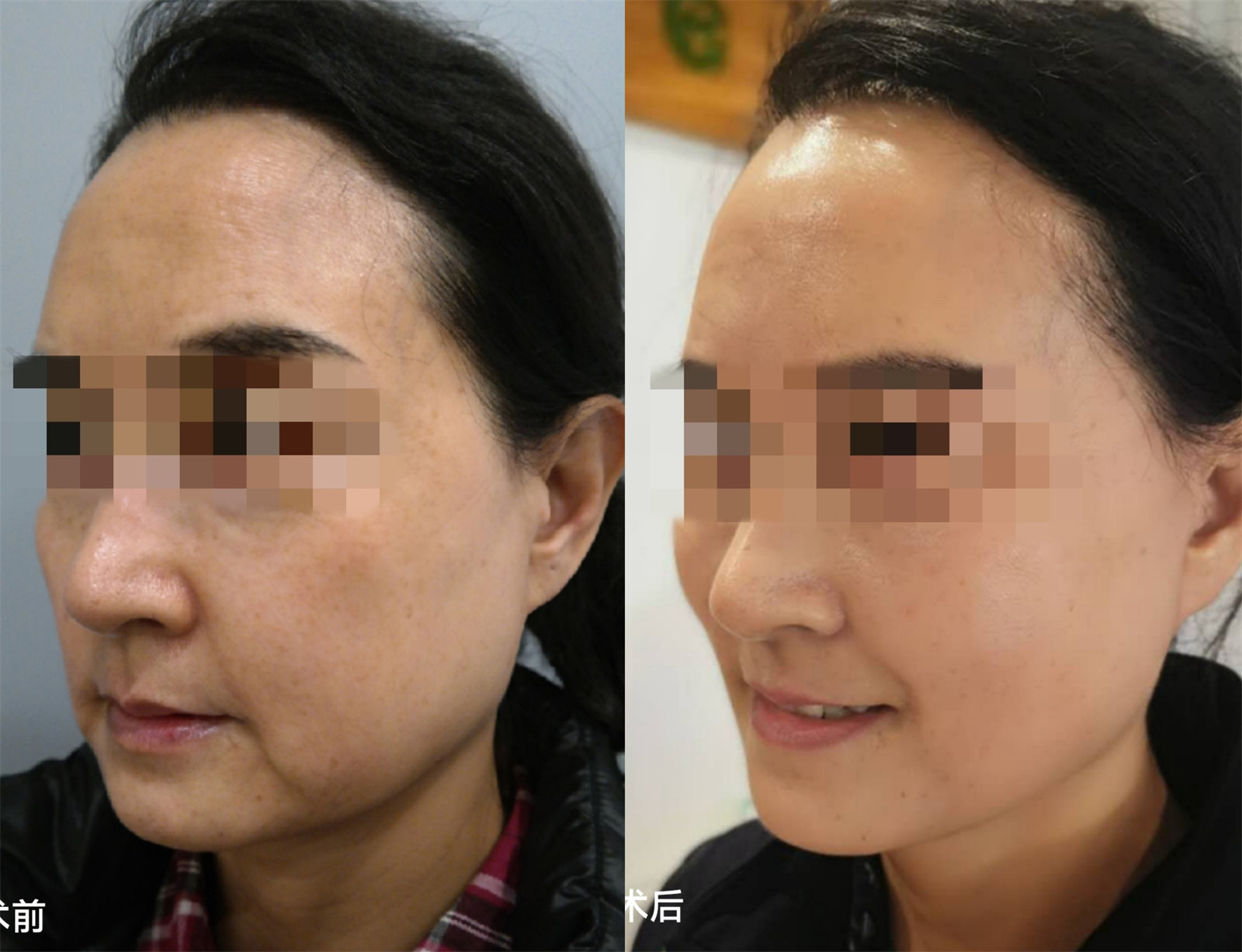 医美小白做拉皮手术前，应如何正确避坑？