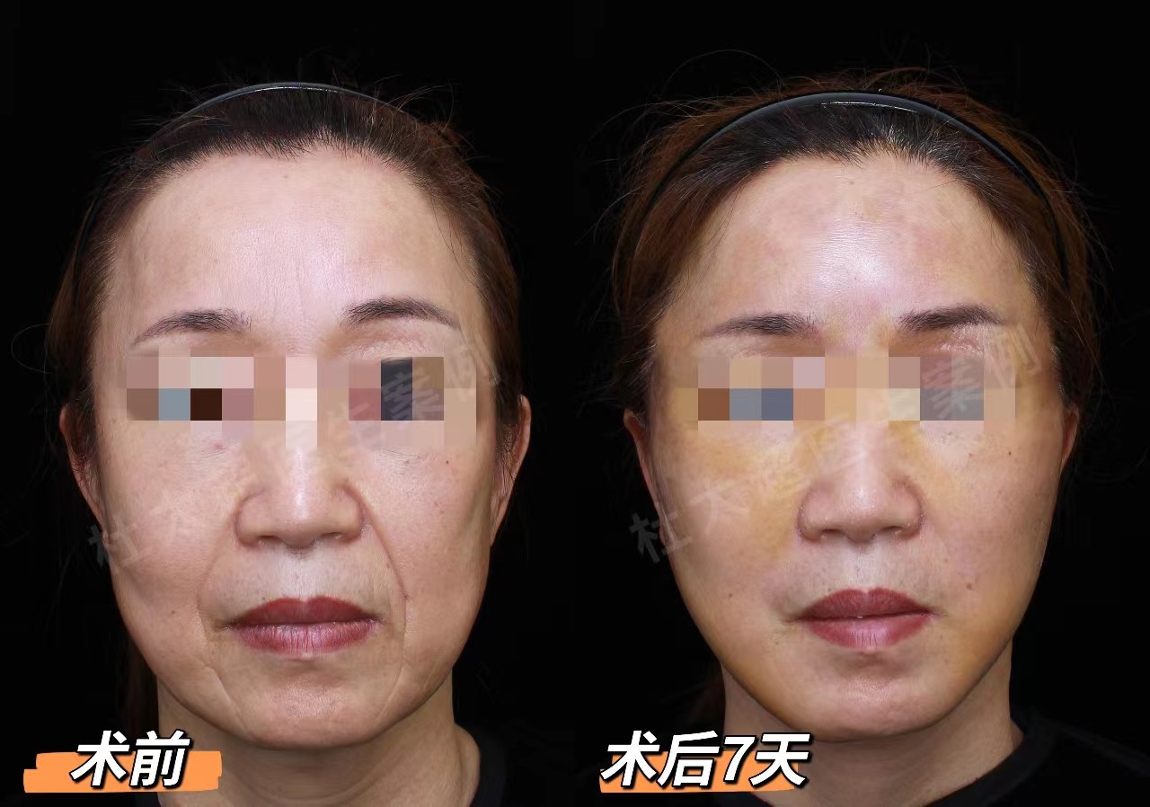 50岁+想做拉皮手术，要做好这3点心理准备！