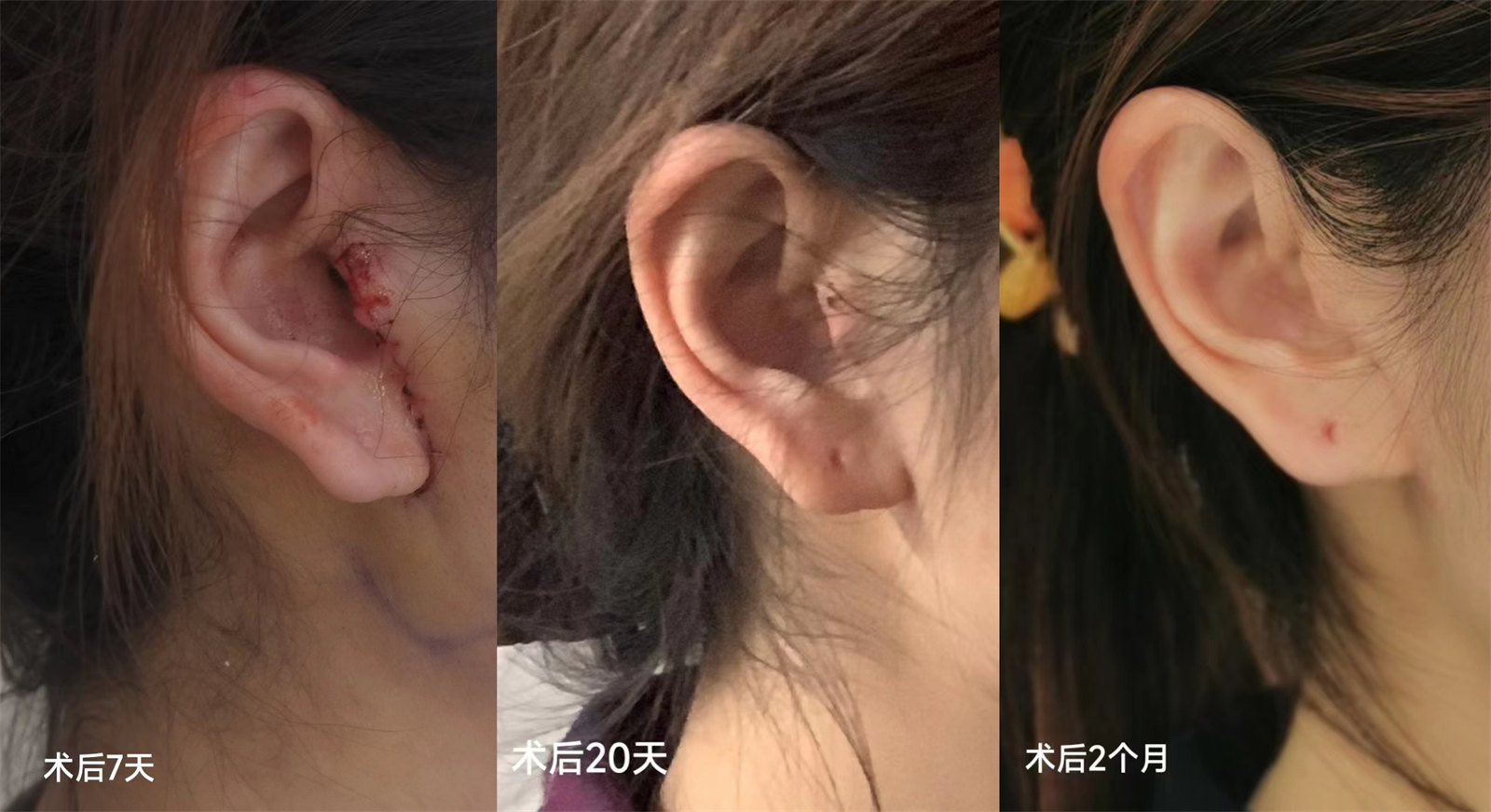 关于拉皮手术，你最关心的三件事，答案全在这里！
