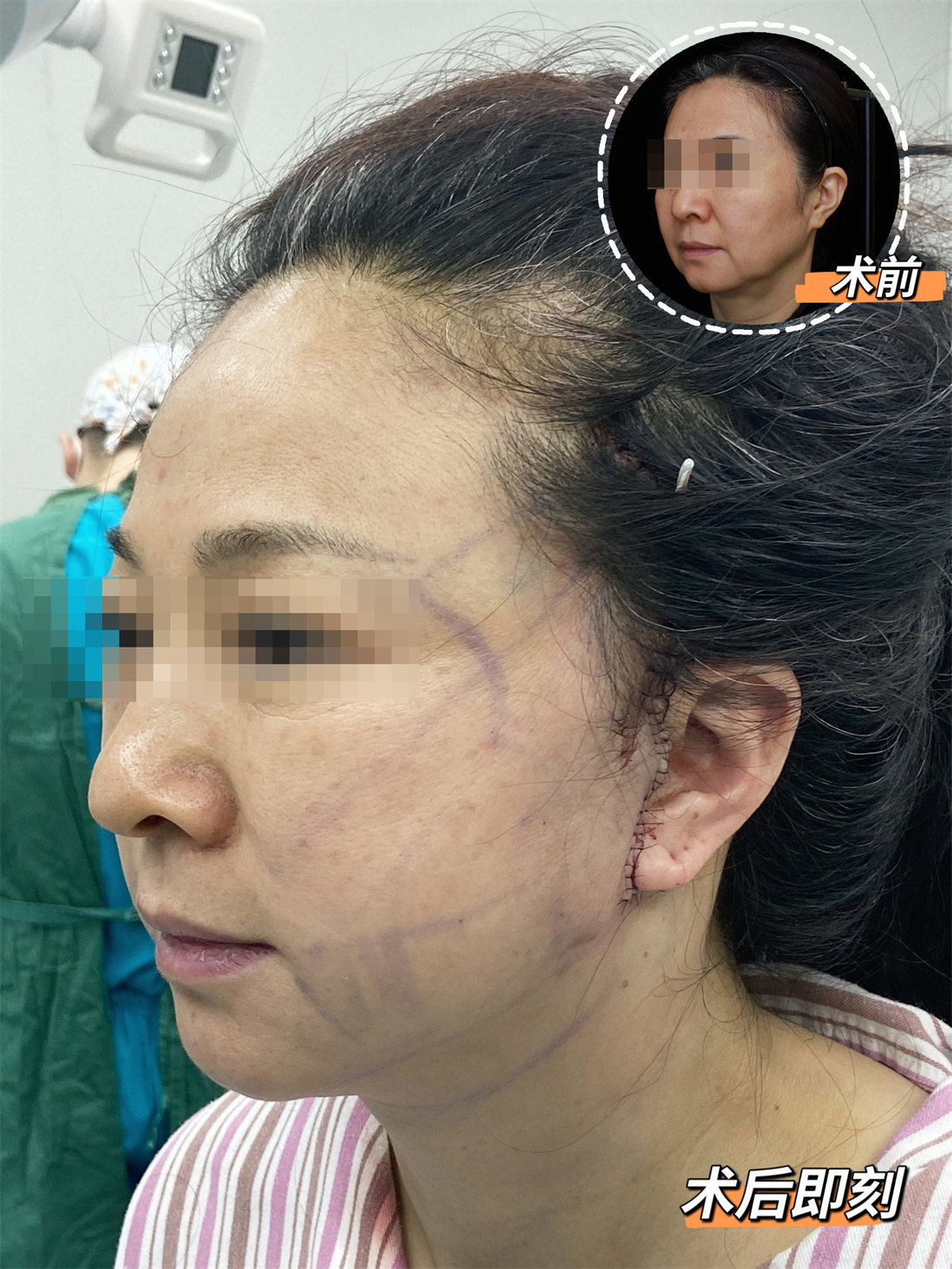 关于拉皮手术，你最关心的三件事，答案全在这里！