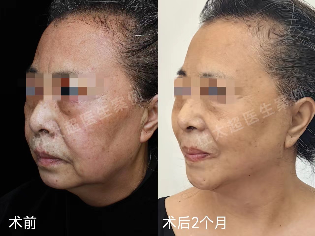 60岁求美者拉皮手术2个月，真实经验分享