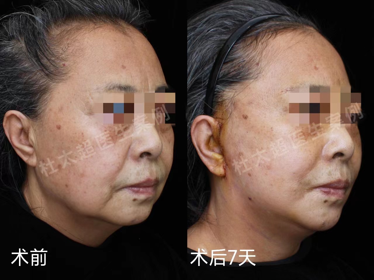 60岁求美者拉皮手术2个月，真实经验分享