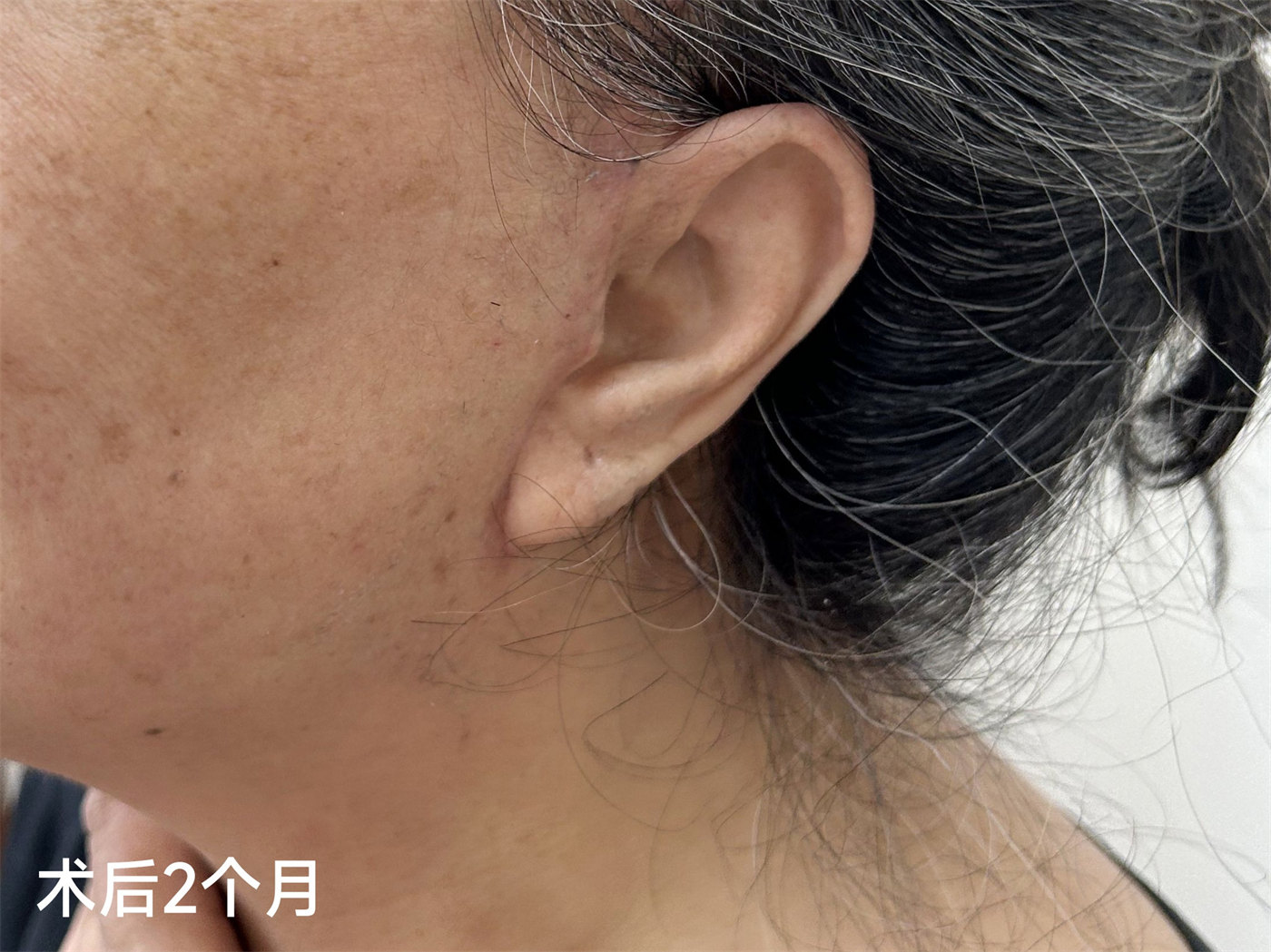 60岁求美者拉皮手术2个月，真实经验分享