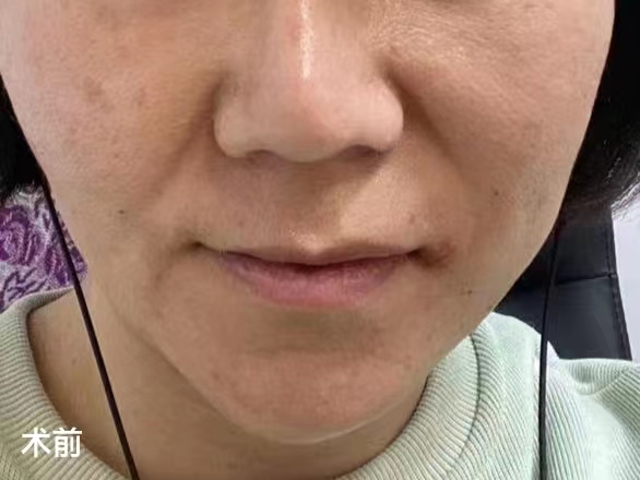 奔着淡化法令纹做了拉皮手术，结果法令纹消失了，太惊喜！