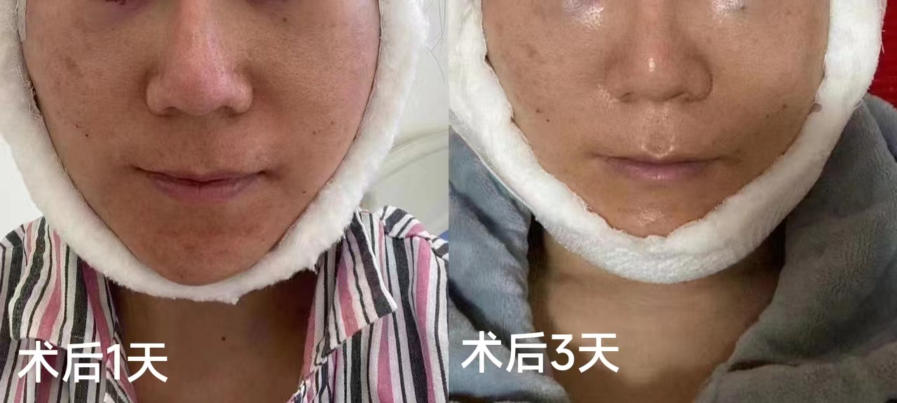 奔着淡化法令纹做了拉皮手术，结果法令纹消失了，太惊喜！