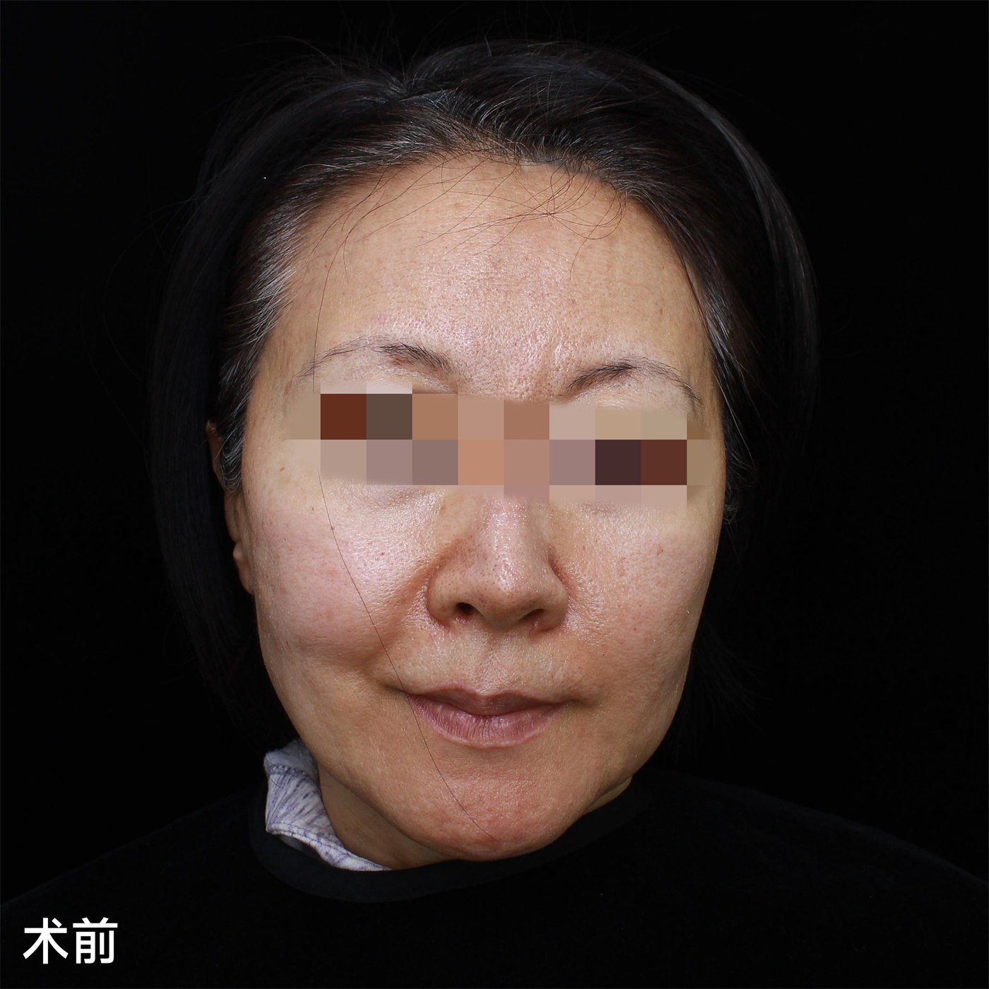53岁选择做了拉皮手术，迎来了迟到10年的逆龄之旅