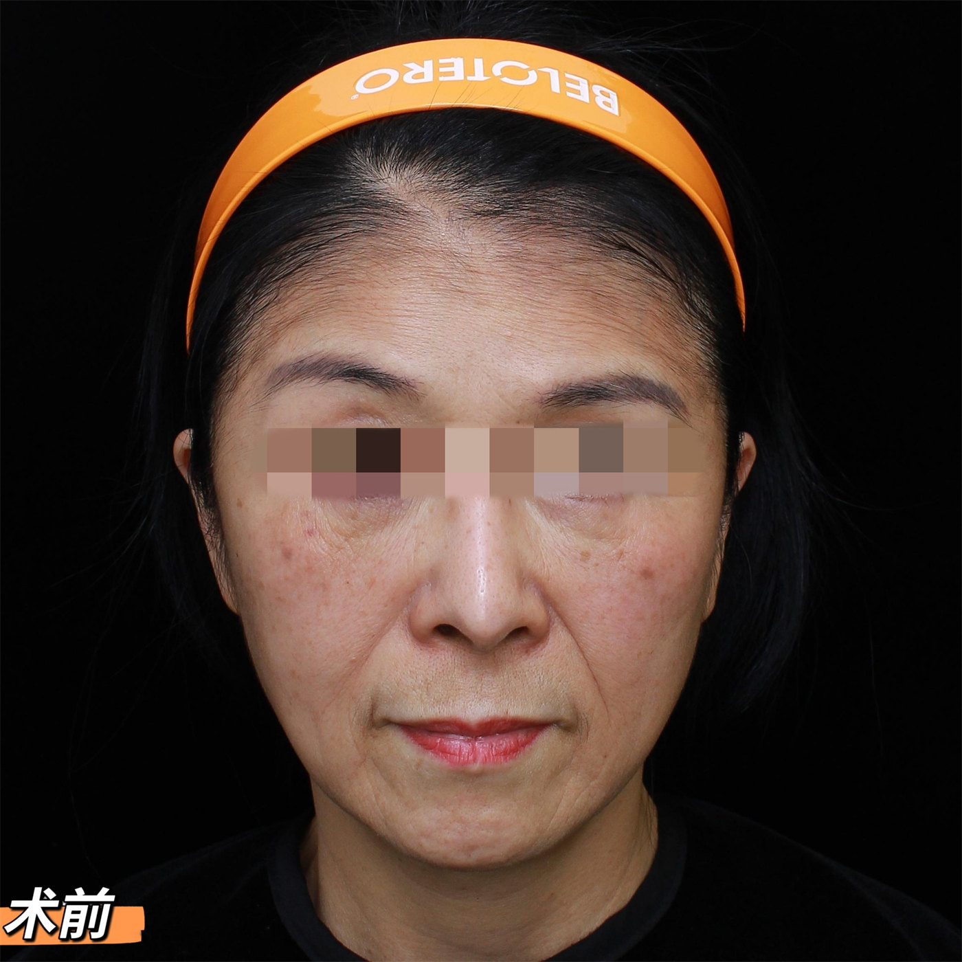 60岁做了拉皮手术，术后7天“大变样”！