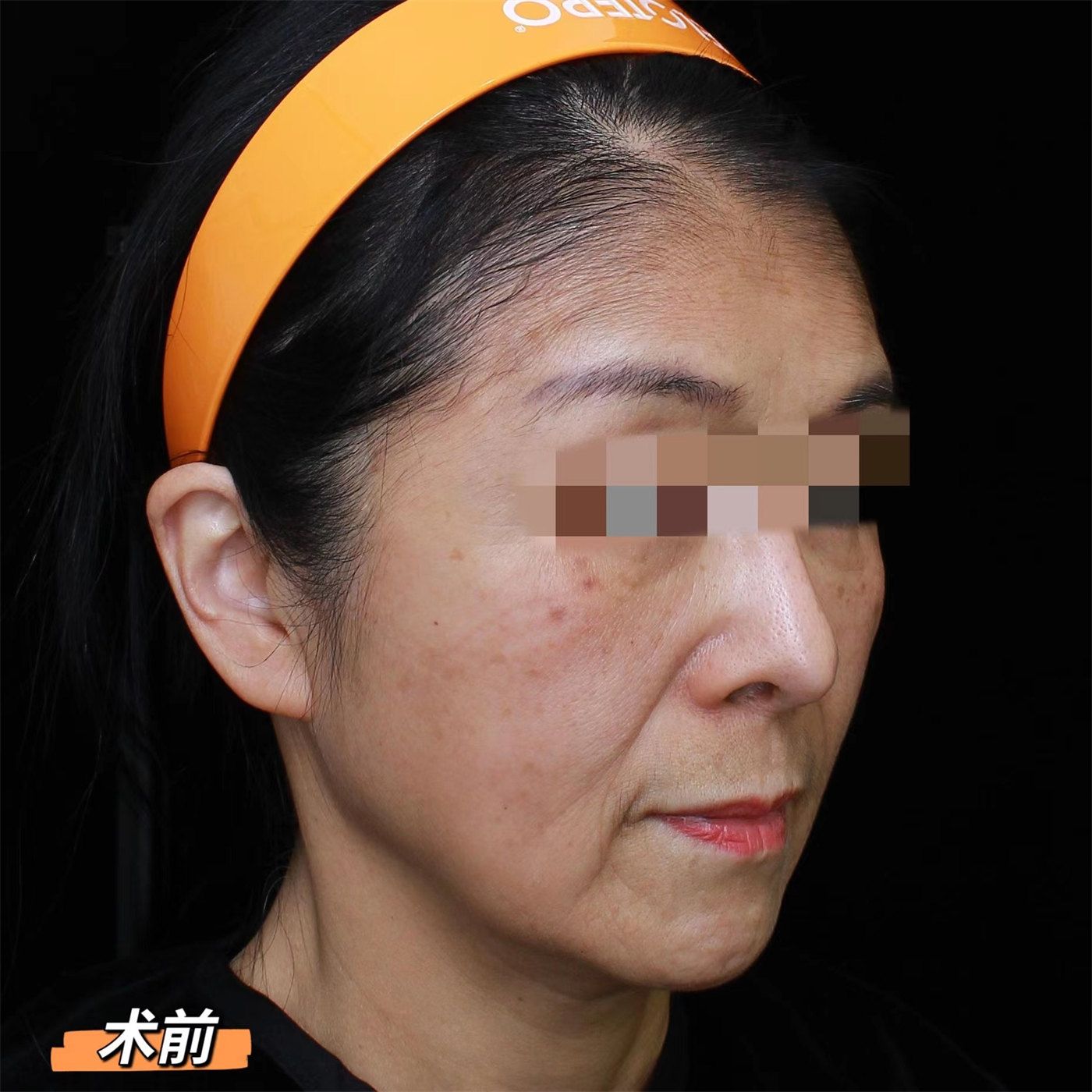 60岁做了拉皮手术，术后7天“大变样”！