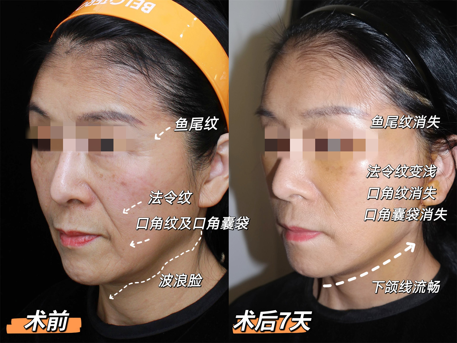 60岁做了拉皮手术，术后7天“大变样”！