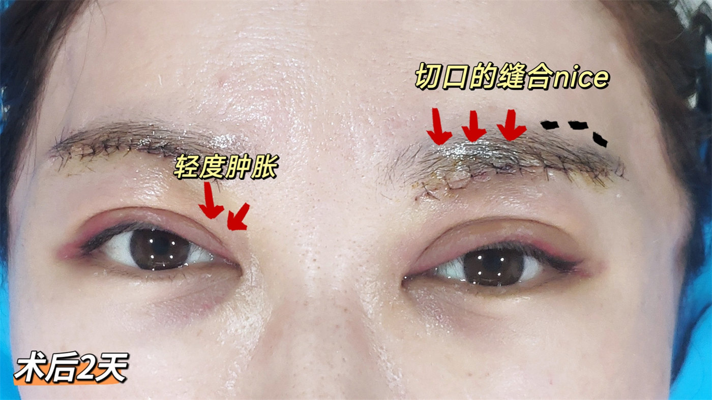 做完切眉术后10天，分享真实术后恢复过程