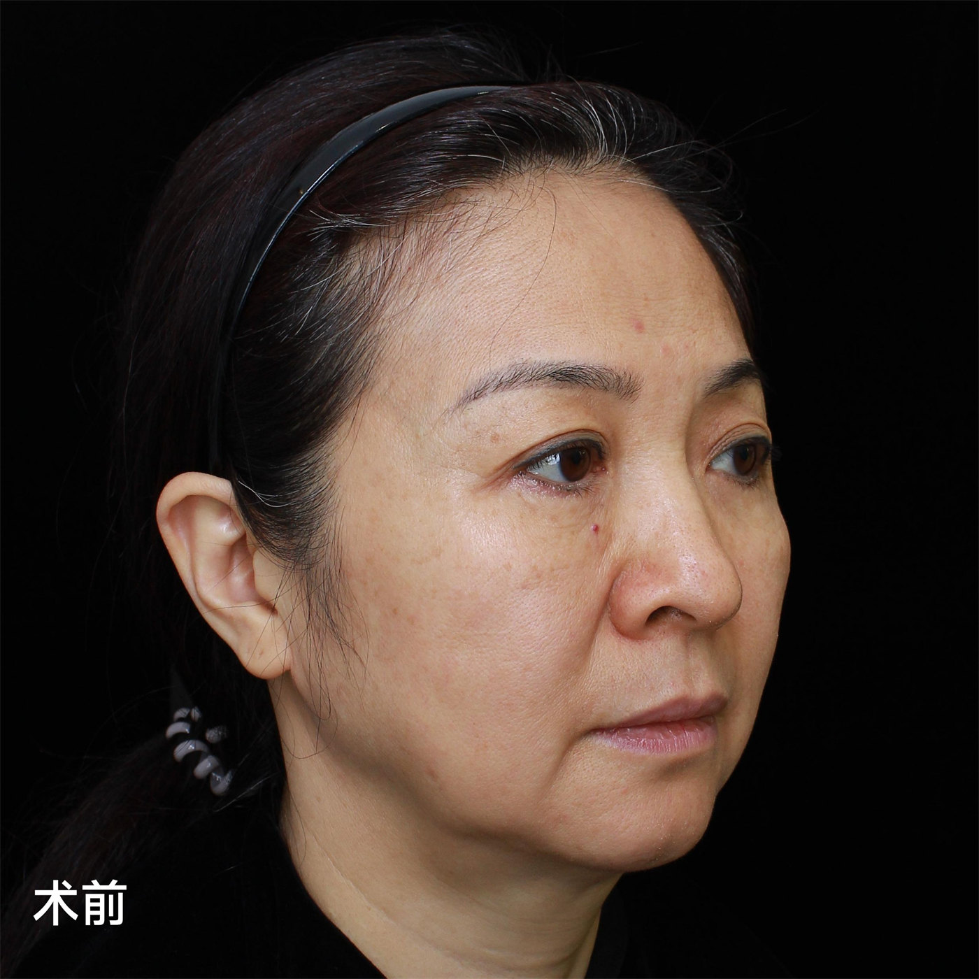 拉皮术后真实记录，52岁居然活成了这个样子