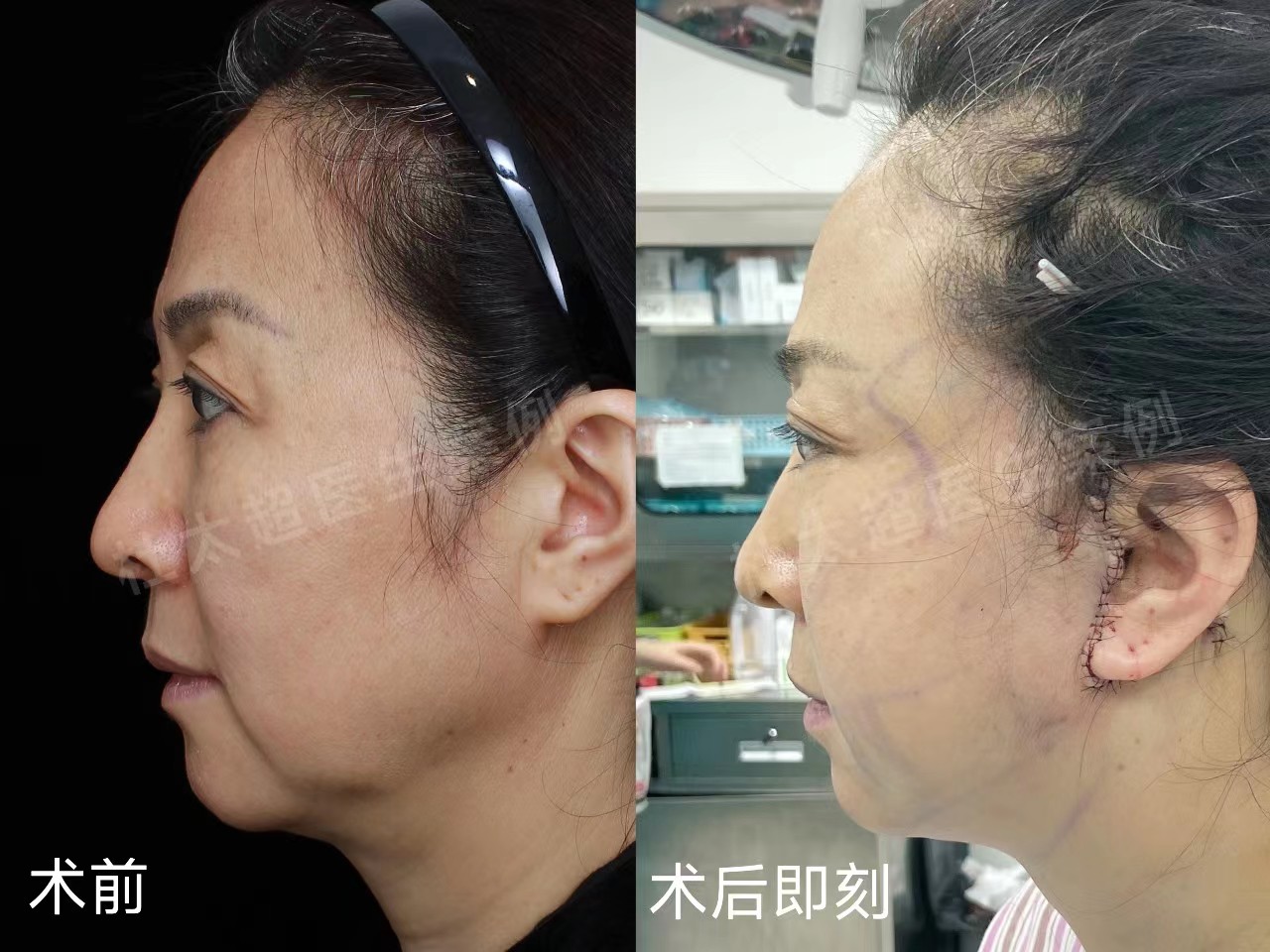 拉皮术后真实记录，52岁居然活成了这个样子