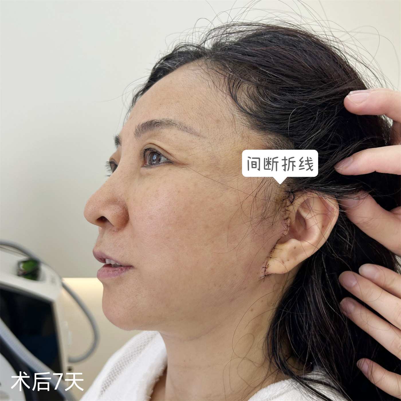 拉皮术后真实记录，52岁居然活成了这个样子