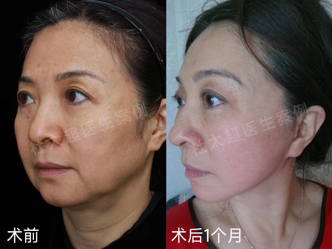拉皮术后真实记录，52岁居然活成了这个样子